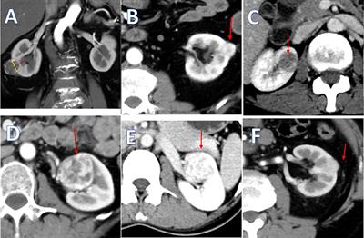 A “3S+f” Nephrometry Score System to Predict the Clinical Outcomes of Laparoscopic Nephron-Sparing Surgery